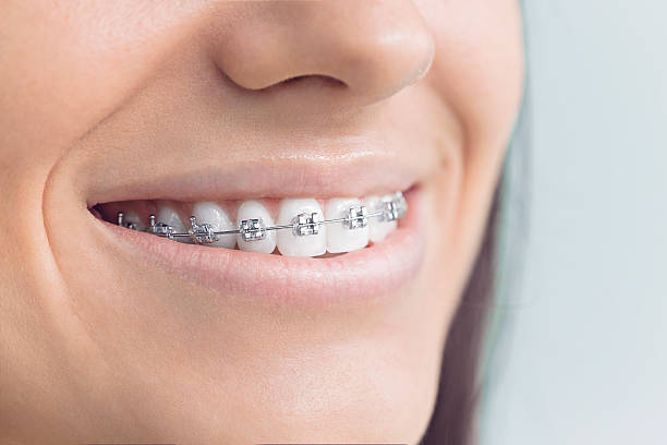 Best Invisalign and Clear Aligners  in Tampa, FL